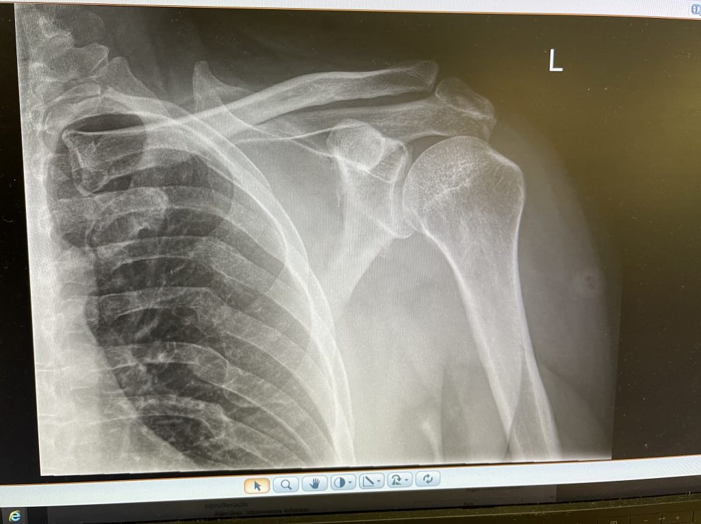 An x-ray of shoulder and ribs.